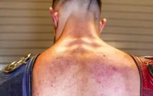 Finn Balor Shows Off Brutal Welts After WWE Payback