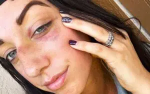 Jacy Jayne Shows Off Nasty Bruises After 4/30 WWE NXT Spring Breakin'