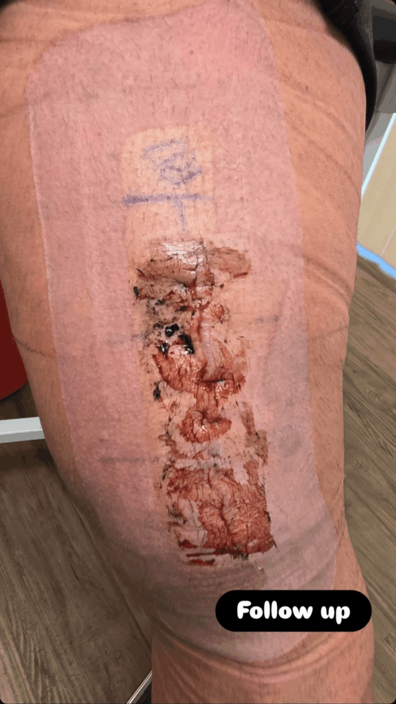 AEW Star Undergoes Knee Surgery During Absence from Television