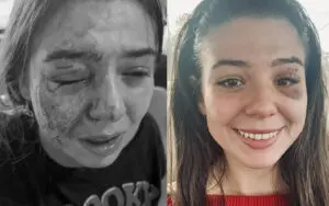 Eddie Guerrero's Daughter Kaylie Reveals Major Progress in Healing From Dog Bite