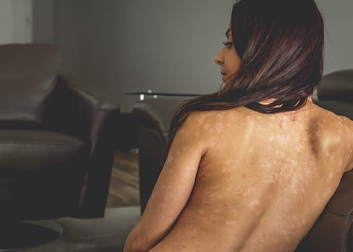 Tenille Dashwood Posts Revealing Photos Opening Up About Her Disease