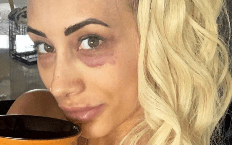 Carmella Shows Off Bruised Face Without Makeup