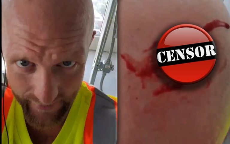 Josh Alexander Posts Graphic Video After Being Injured At His Day Job