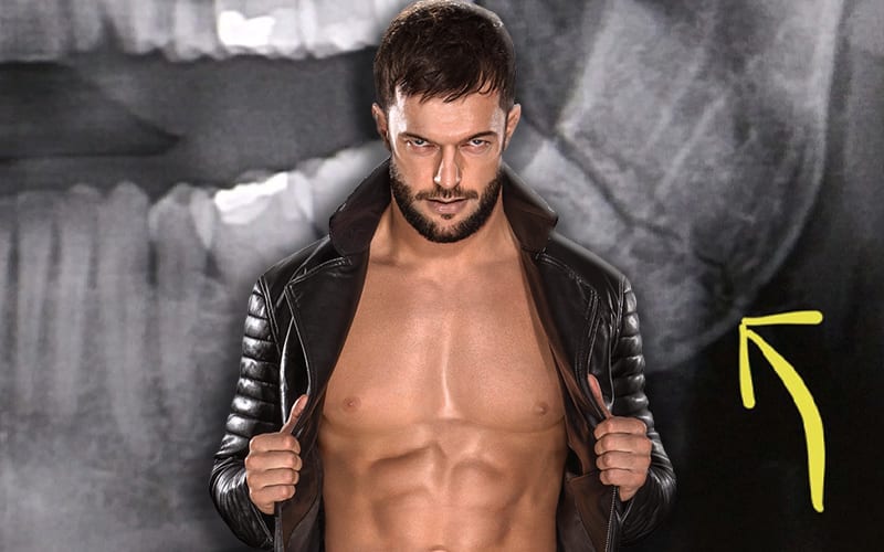 Finn Balor Reveals His Jaw Is Broken In Two Places