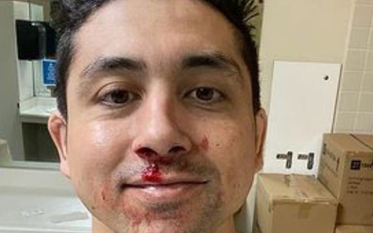 TJP Goes Under The Knife To Fix Busted Nose
