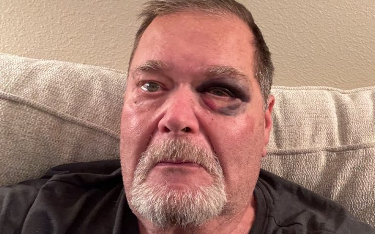 Jim Ross Gets A Black Eye After Suffering A Fall