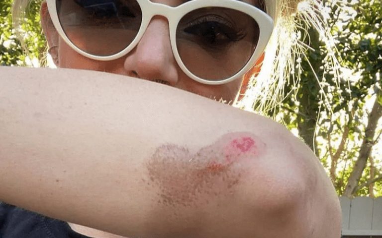 Alexa Bliss Shows Off Major Road Rash After Wiping Out At Disneyland