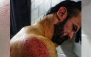 Drew McIntyre Shows Off Ridiculous Bruises After Brutal Attack On SmackDown