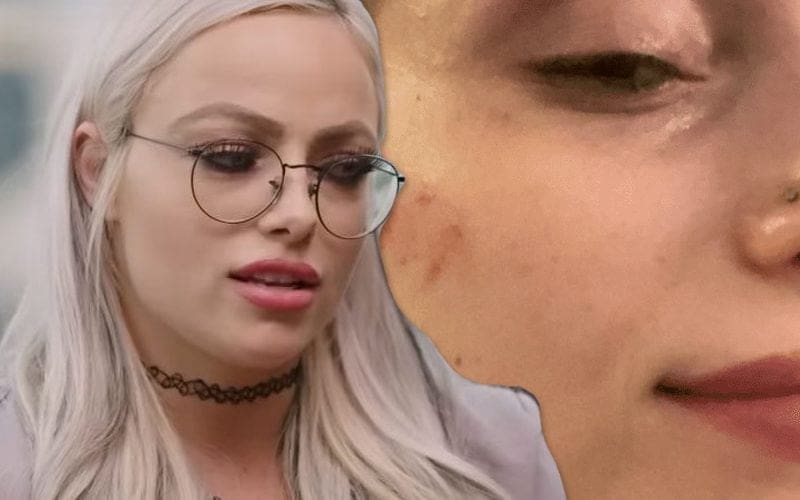 Liv Morgan Shows Off Nasty Bruises After Vicious Shayna Baszler Attack