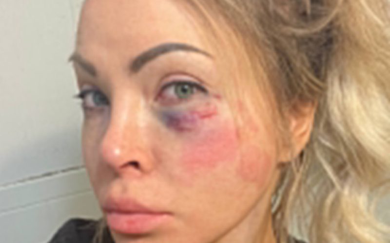 Natalia Markova Shows Off Nasty Bruises On Her Face After Recent Match