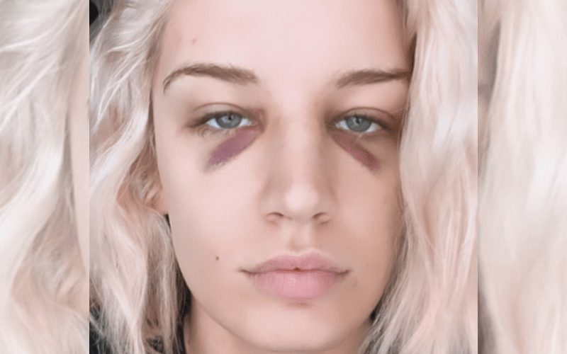 Toni Storm Shows Off Nasty Face Injury After AEW Full Gear