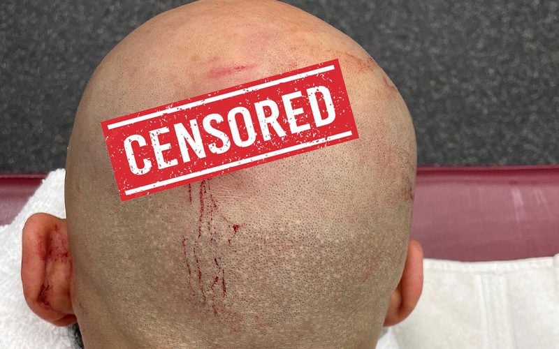 Ricochet Shows Off Nasty Stitches After WWE SmackDown