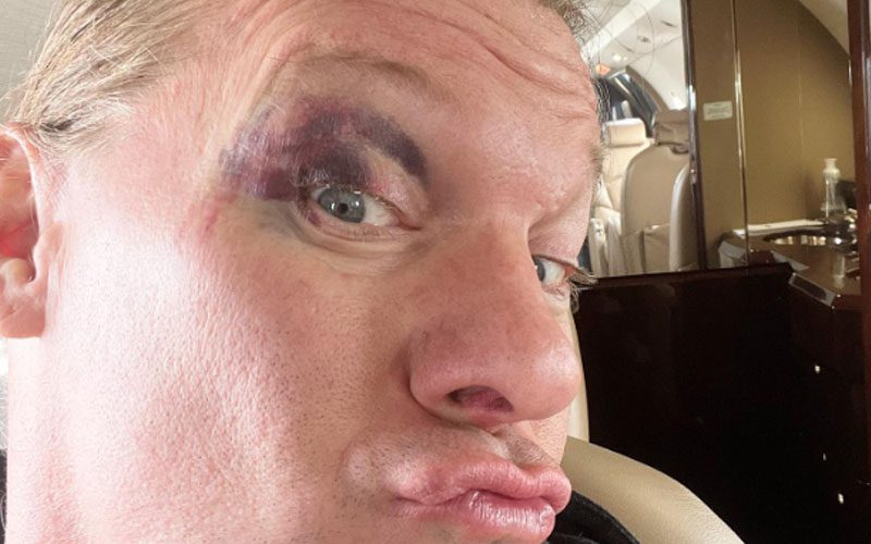 Chris Jericho Shows Off Nasty Face Bruise After AEW Dynamite