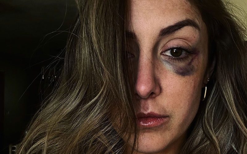 Britt Baker Shows Off Nasty Wounds After AEW Dynamite Beatdown