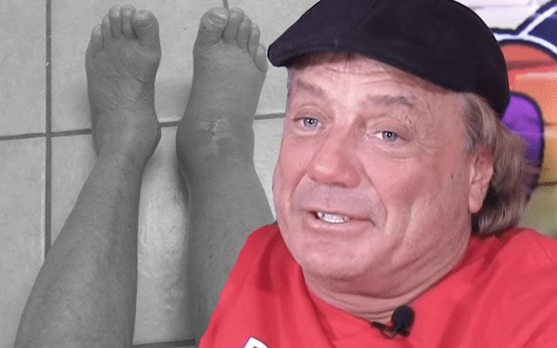 Marty Jannetty Posts Photo Of His Ankle After Surgery