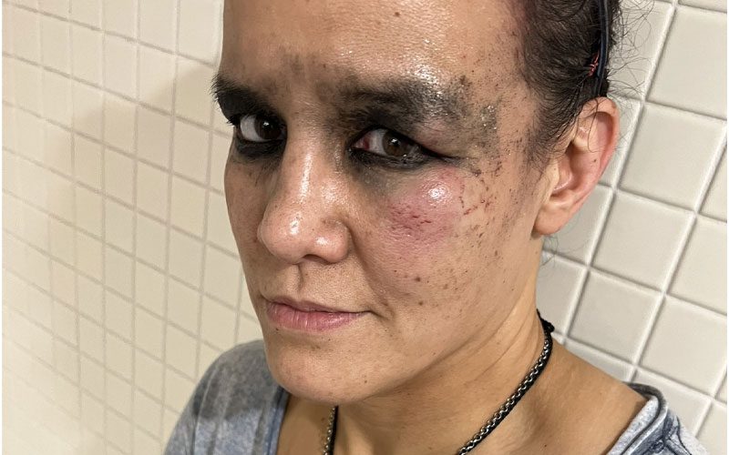 Shayna Baszler Shows Off Nasty Bruises After WWE SummerSlam