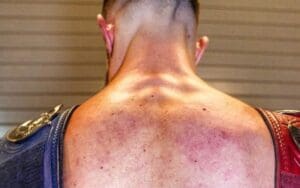 Finn Balor Shows Off Brutal Welts After WWE Payback