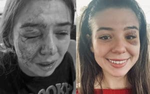 Eddie Guerrero's Daughter Kaylie Reveals Major Progress in Healing From Dog Bite