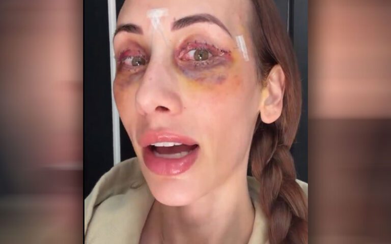 Ex-WWE Star Carmella Shows Off Bruising After Eye Surgery